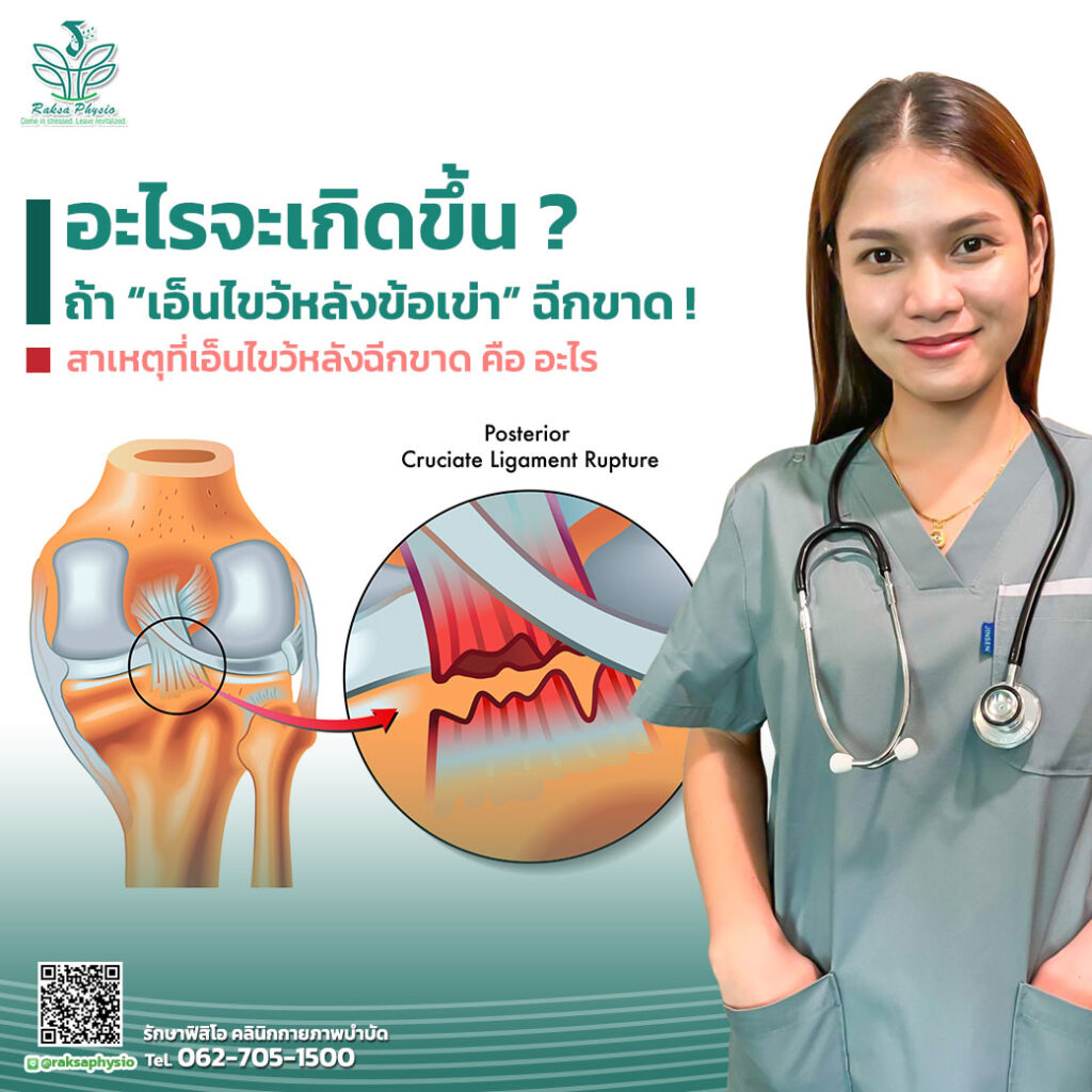 เอ็นไขว้หลังข้อเข่า-ฉีกขาด
